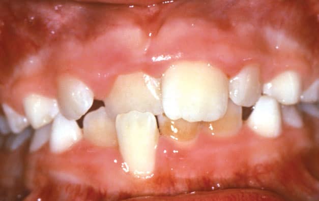 Crossbite Becker and Scott Orthodontics in Springfield, MO