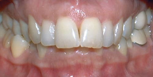 Overbite Becker and Scott Orthodontics in Springfield, MO