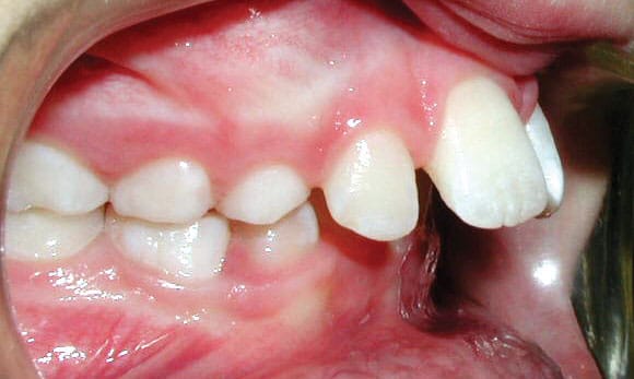 Protrusion Becker and Scott Orthodontics in Springfield, MO