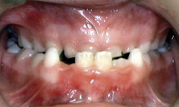 Underbite Becker and Scott Orthodontics in Springfield, MO