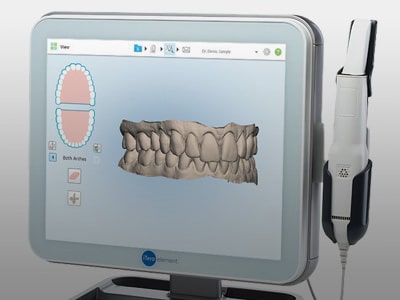 Digital Impressions Becker and Scott Orthodontics in Springfield, MO